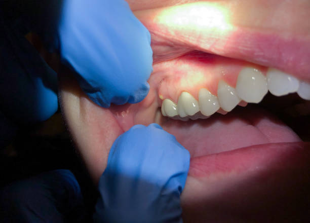 Best Emergency Treatment for Toothache in Lees Summit, MO